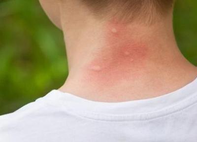 روش های خانگی برای توقف خارش جای نیش پشه روش های خانگی برای توقف خارش جای نیش پشه